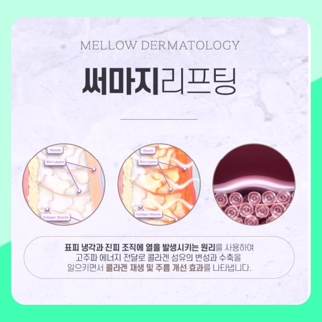 마포 울쎄라, 써마지 리프팅은 왜 표면을 차갑게 유지하나요? 멜로우피부과 공덕점